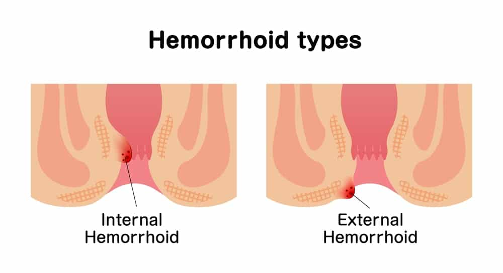 hemorrhoid type