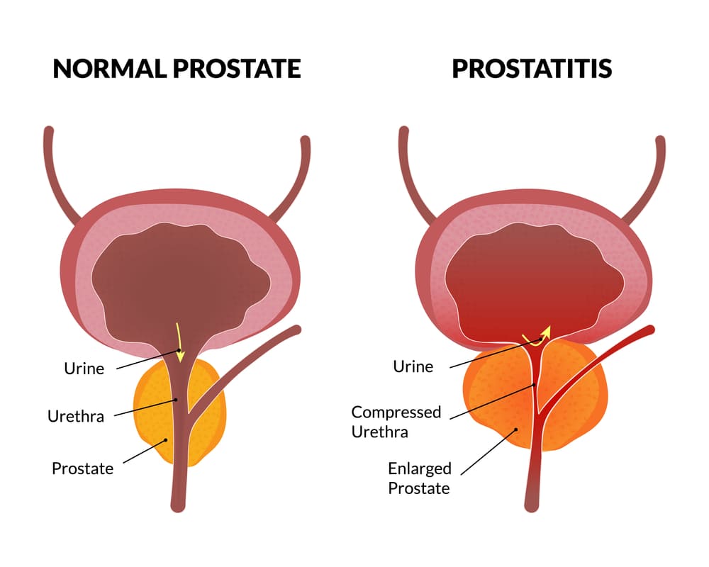 bacterial prostatitis